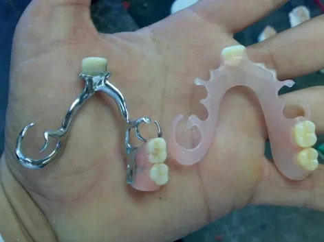 Próteses parciais esquelética e acrílica feitas no laboratório